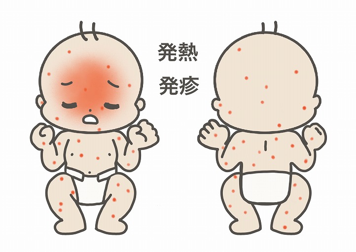 4歳以下の子どもに発症しやすい「川崎病」とは？